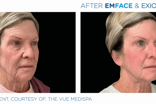 Emface_Exion_PIC_Ba-card-face-female-013_ENUS100 (1)