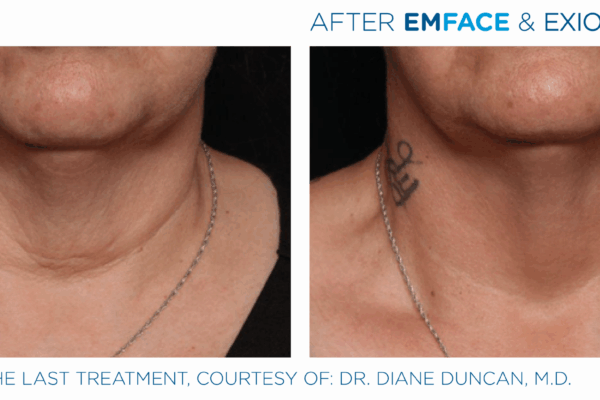 Emface_Exion_PIC_Ba-card-neck-female-003_FRF_Face_ENUS100 (2)