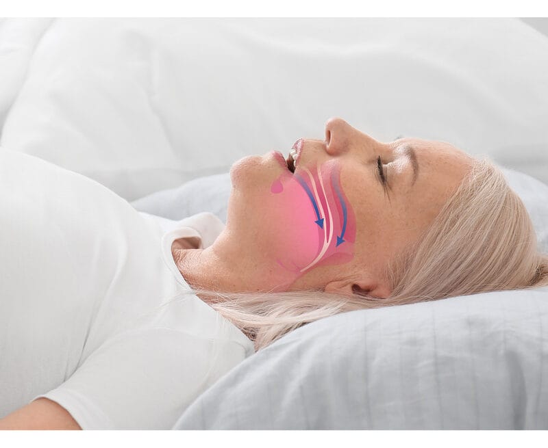 oman lying on her back with a medical illustration of airway obstruction overlaid on her throat, representing the health risks and breathing disruption caused by untreated sleep apnea