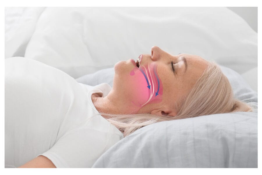 oman lying on her back with a medical illustration of airway obstruction overlaid on her throat, representing the health risks and breathing disruption caused by untreated sleep apnea