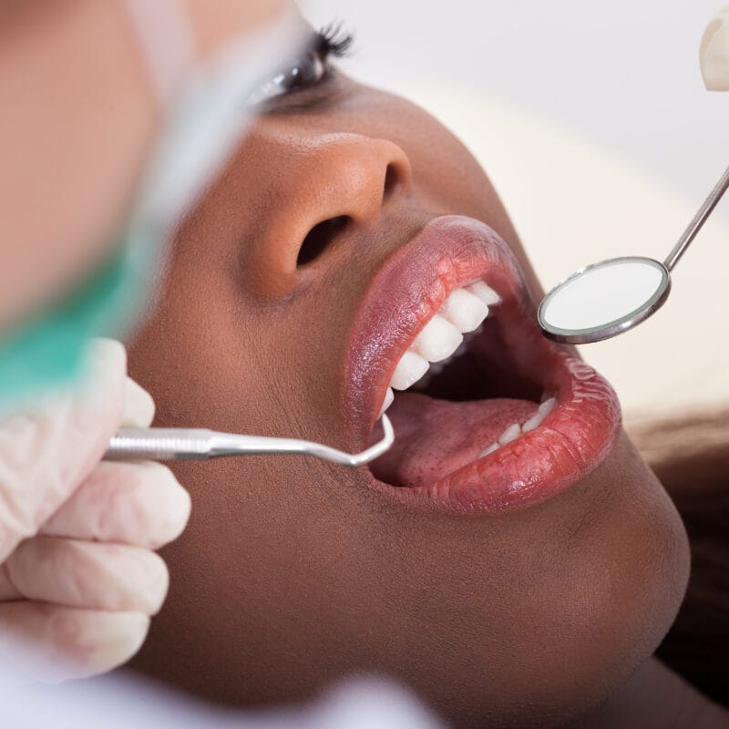 Close-up of a patient receiving a dental exam with mirror and probe instruments, highlighting assessment for root canal treatment – Root Canals