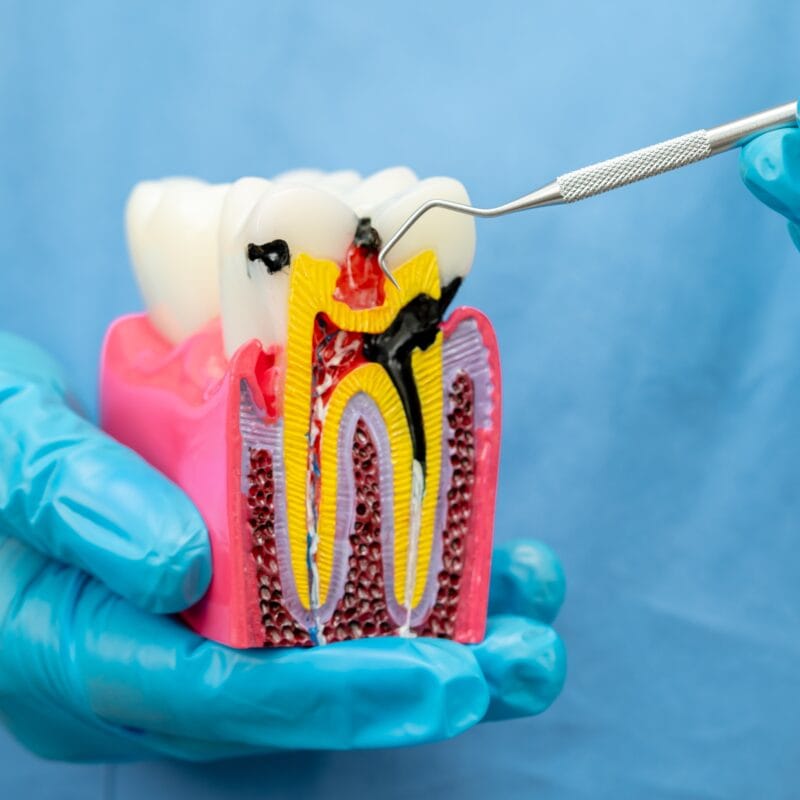 Gloved dental professional holding a cross-section model of a decayed tooth showing inflamed pulp and infection, used to explain the root canal procedure